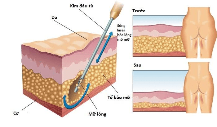 Cơ chế giảm béo bằng công nghệ laser kết hợp hút mỡ