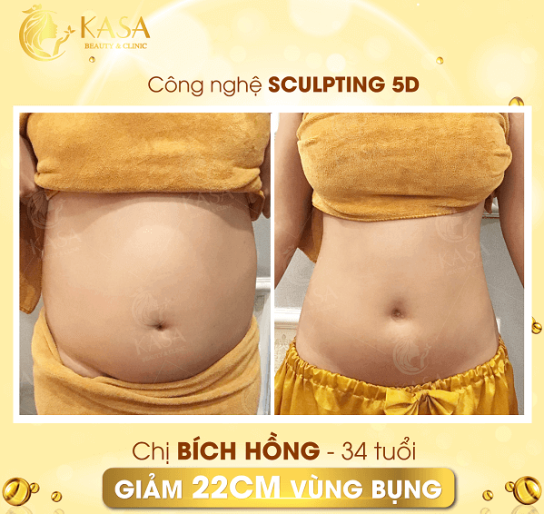 Kết quả giảm 22cm vòng bụng sau liệu trình Sculpting 5D của chị Bình Hồng.