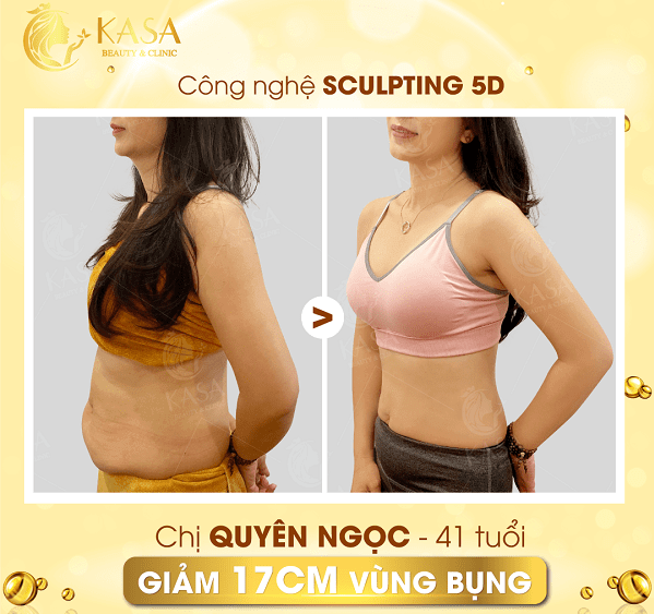 Kết quả hủy mỡ không xâm lấn của chị Quyên Ngọc 41 tuổi, nhân viên ngân hàng.