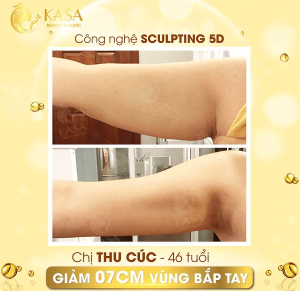 Chị Thu Cúc hủy mỡ bắp tay thành công sau 1 liệu trình hủy mỡ không xâm lấn tại KASA.